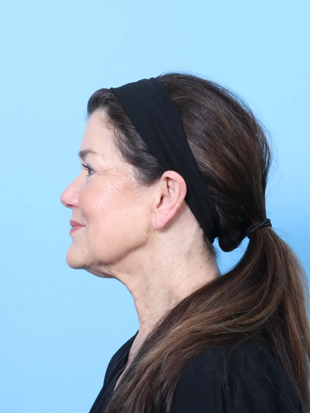 Eyelid Surgery Patient Photo - Case 57581 - after view-2