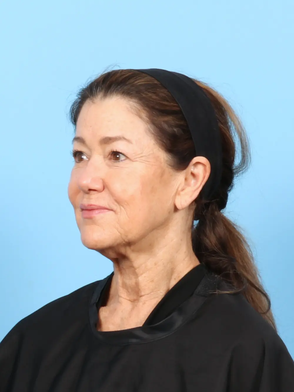 Eyelid Surgery Patient Photo - Case 57581 - before view-1