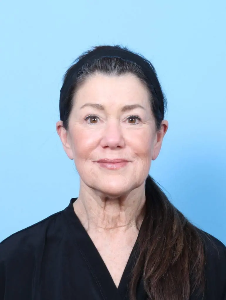 Eyelid Surgery - Case 57581 - After