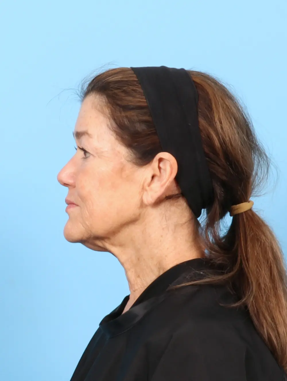 Eyelid Surgery Patient Photo - Case 57581 - before view-2
