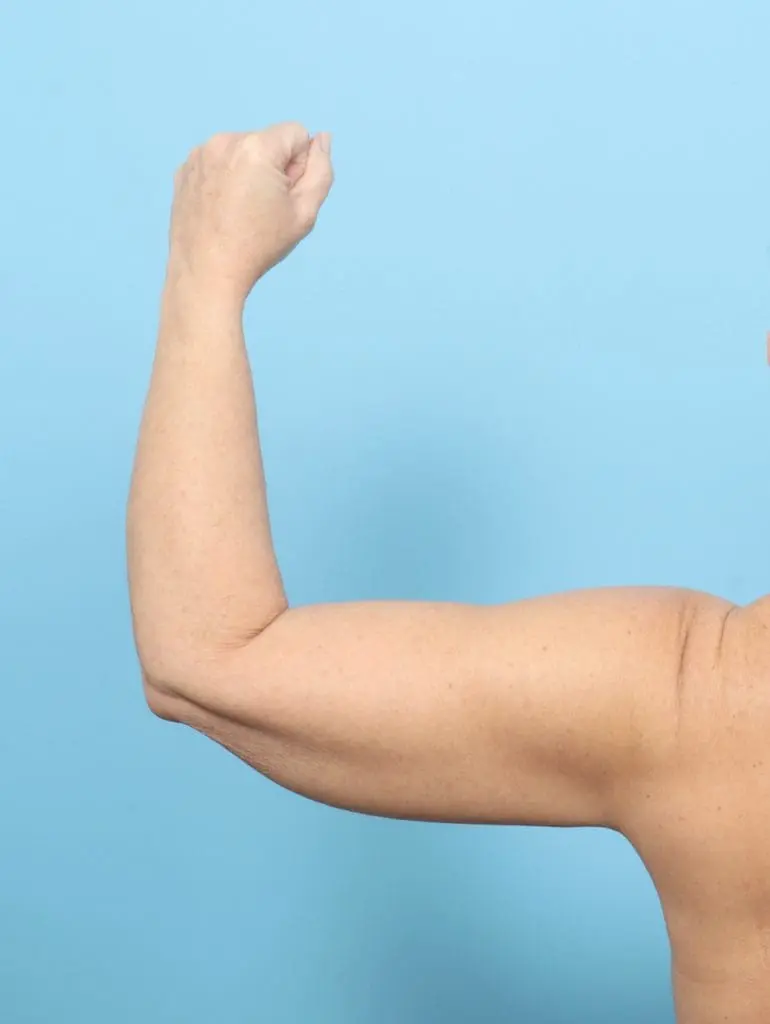 After Weight Loss - Case 57606 - After