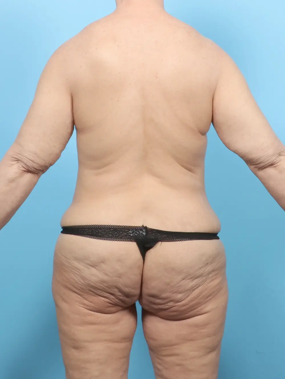 After Weight Loss Patient Photo - Case 57583 - before view-3