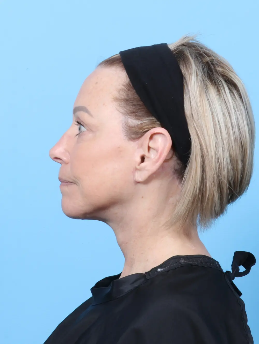 Eyelid Surgery Patient Photo - Case 57617 - after view-2