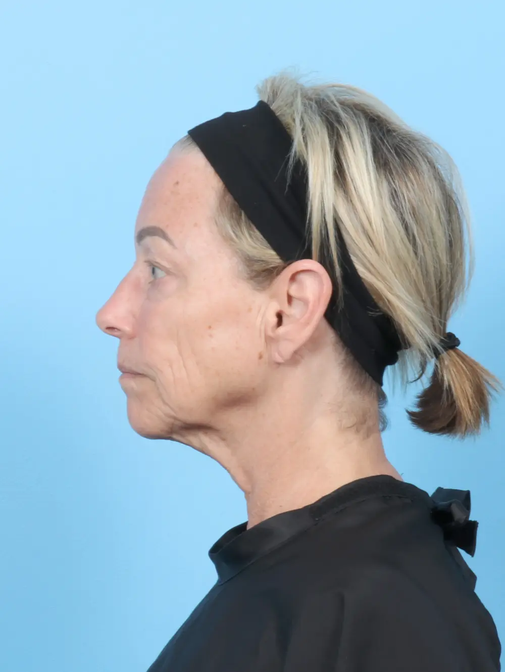 Eyelid Surgery Patient Photo - Case 57617 - before view-2