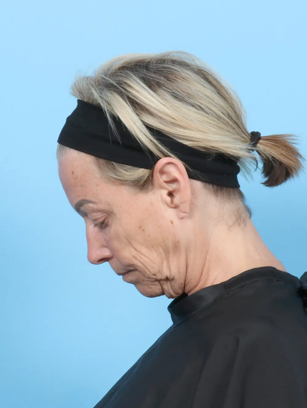 Eyelid Surgery Patient Photo - Case 57617 - before view-3