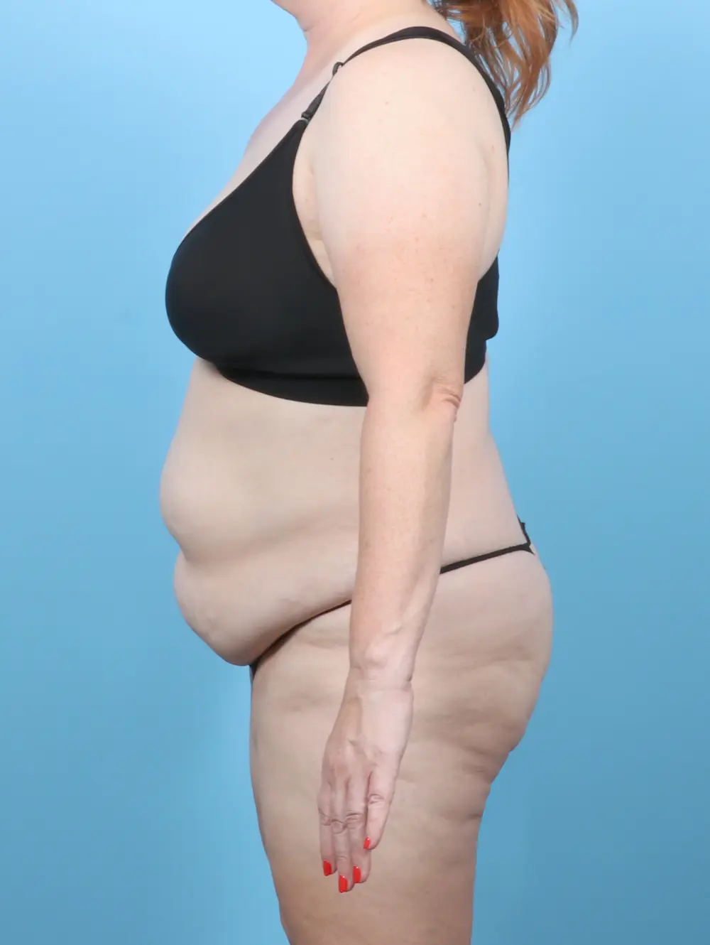 Tummy Tuck Patient Photo - Case 57627 - before view-2