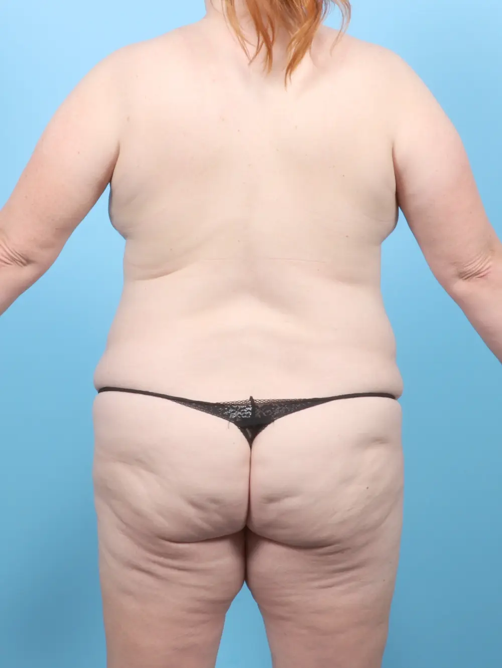 Tummy Tuck Patient Photo - Case 57627 - before view-3