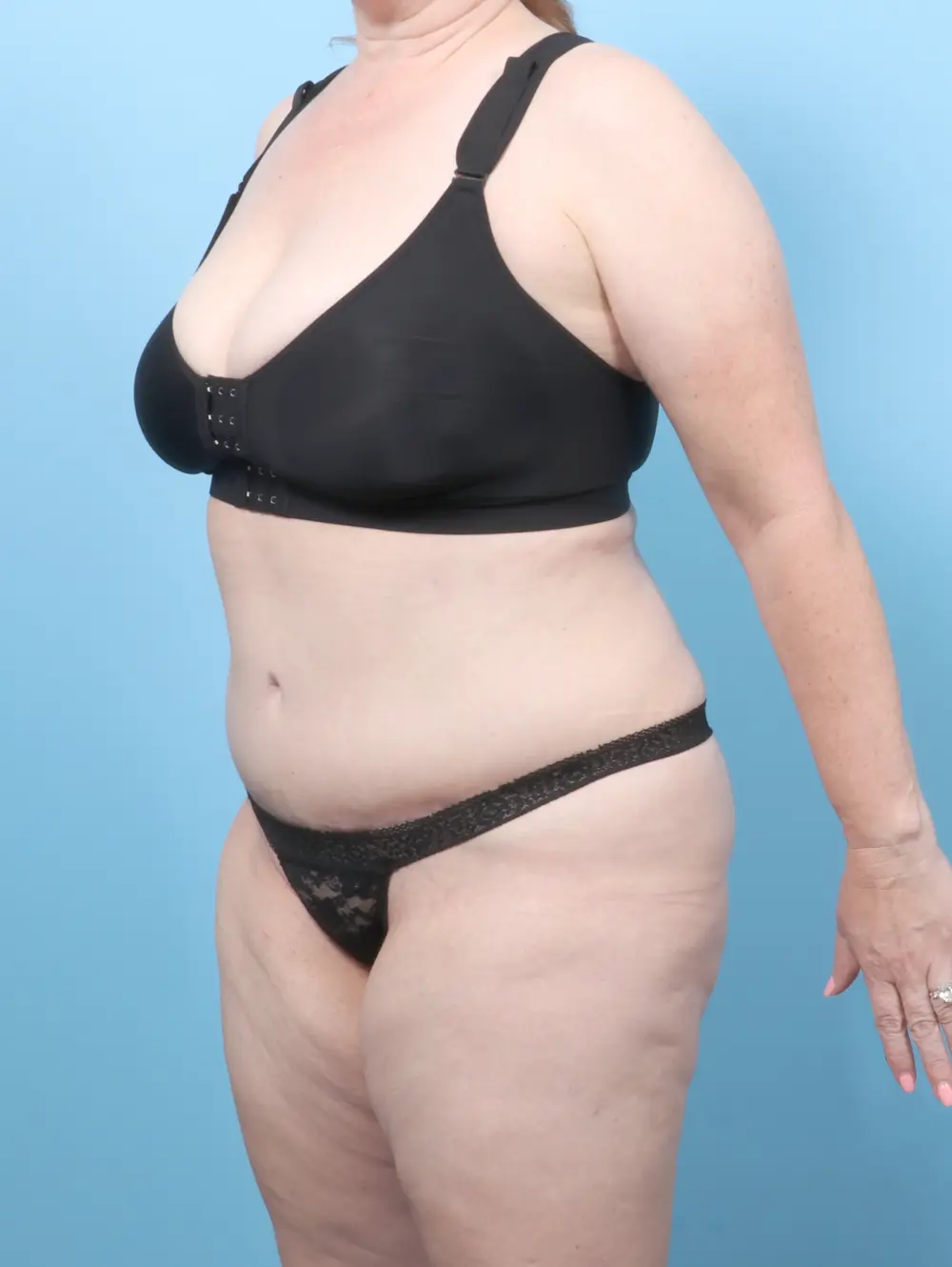 Tummy Tuck Patient Photo - Case 57627 - after view-1