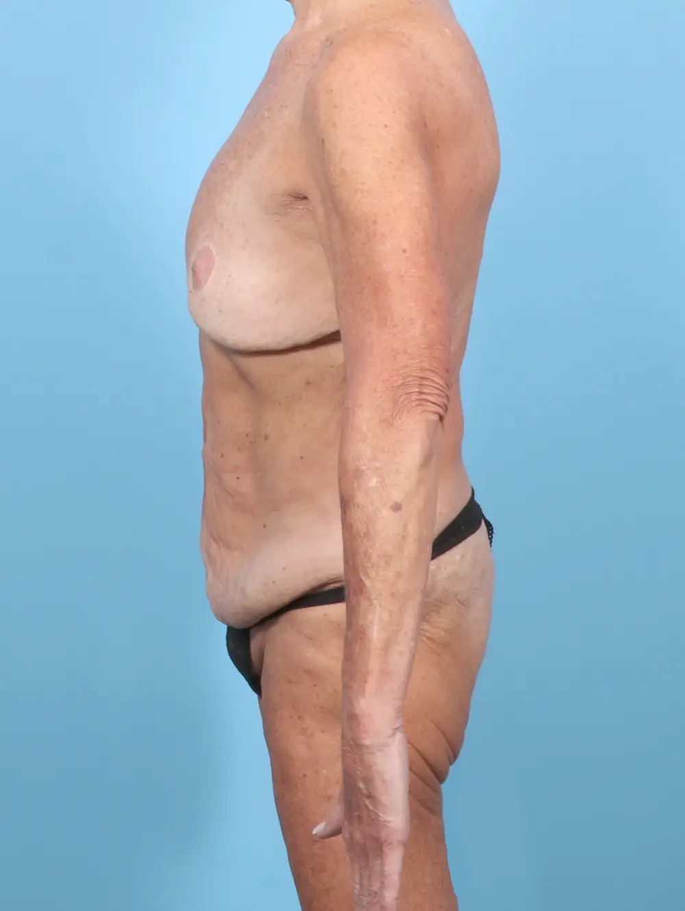 After Weight Loss Patient Photo - Case 57681 - before view-2