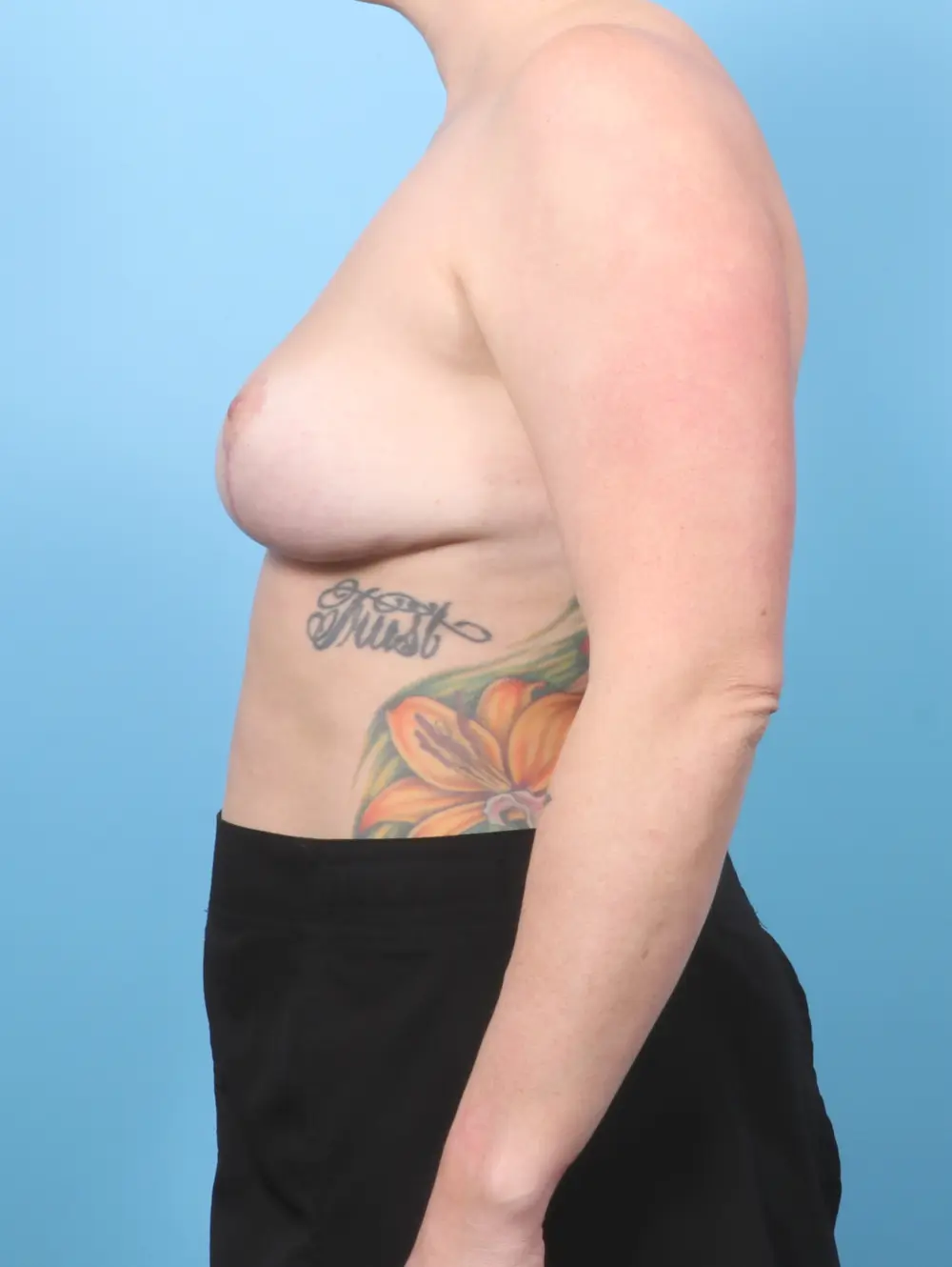 Breast Implant Removal Patient Photo - Case 57689 - after view-2
