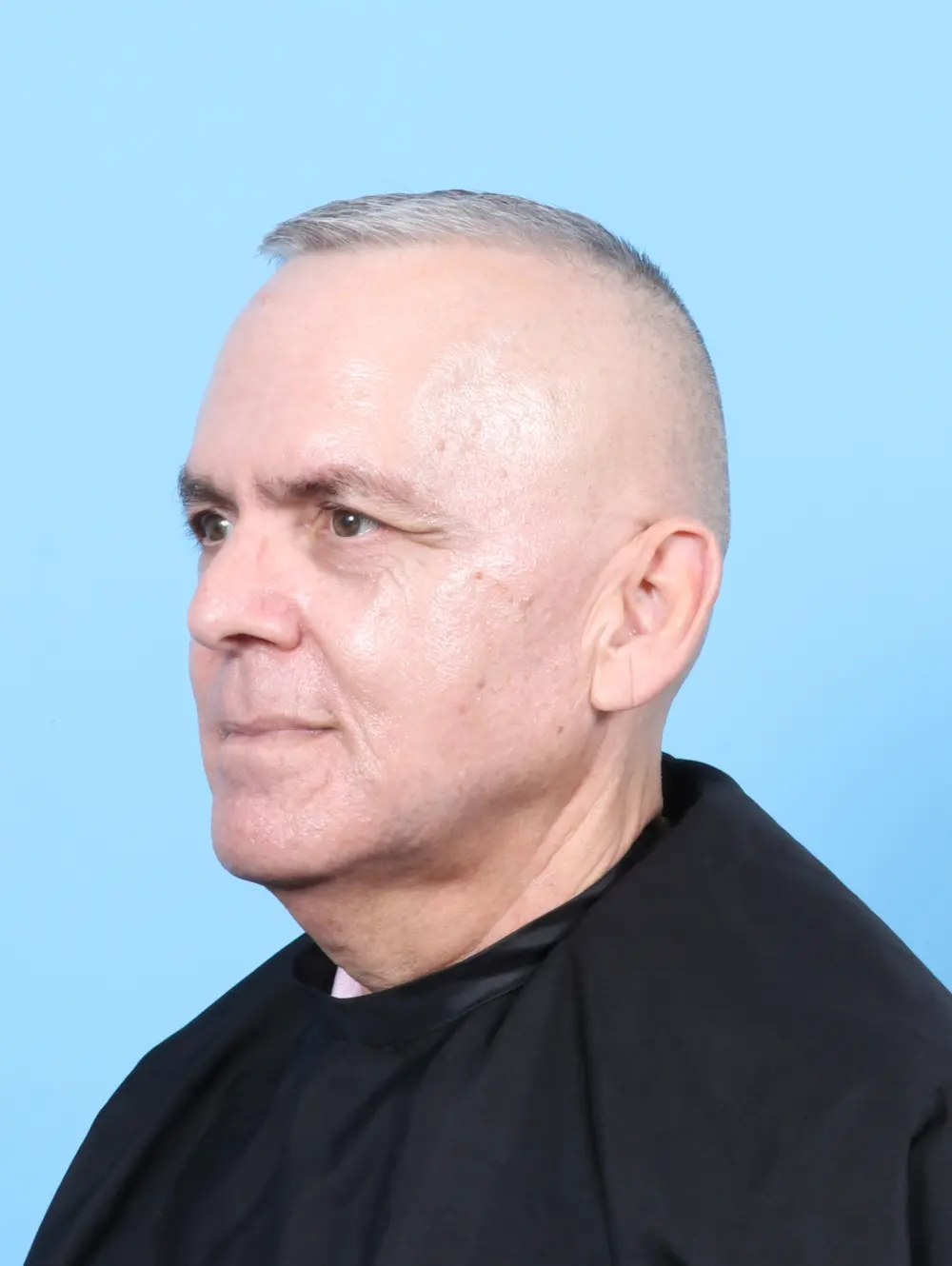 Eyelid Surgery Patient Photo - Case 57697 - before view-1