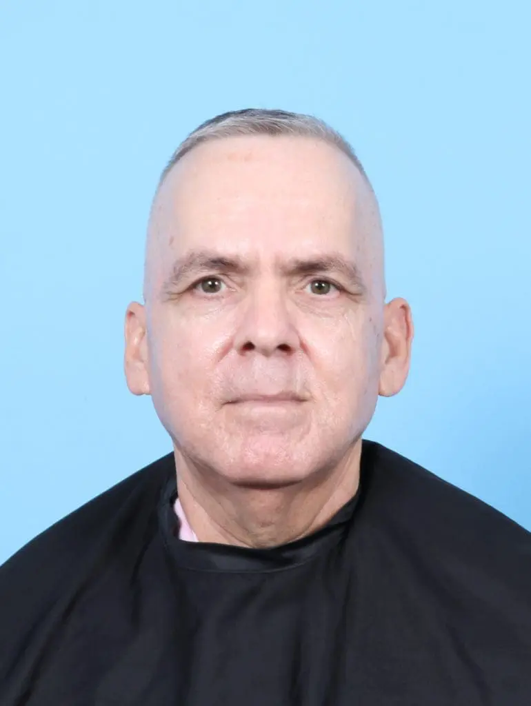 Eyelid Surgery - Case 57697 - Before