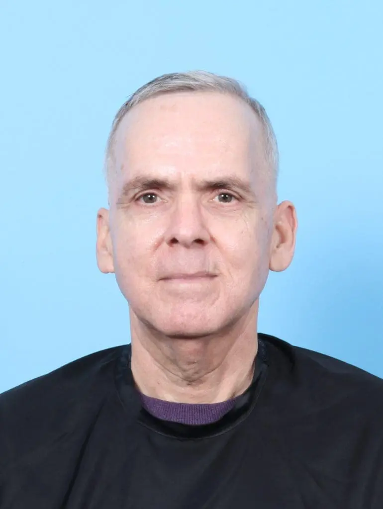 Eyelid Surgery - Case 57697 - After