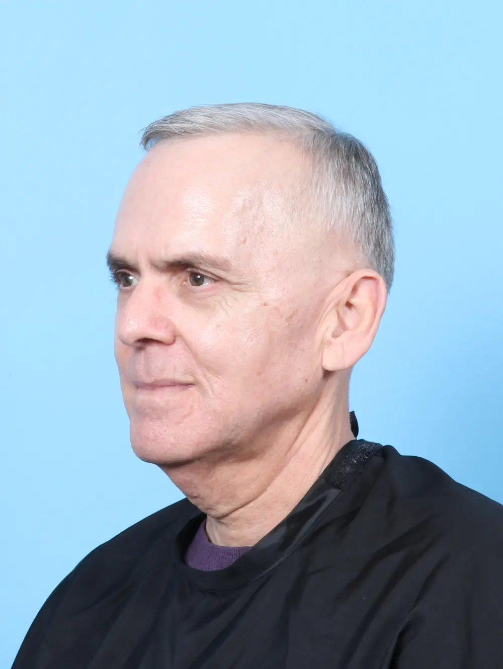 Eyelid Surgery Patient Photo - Case 57697 - after view-1