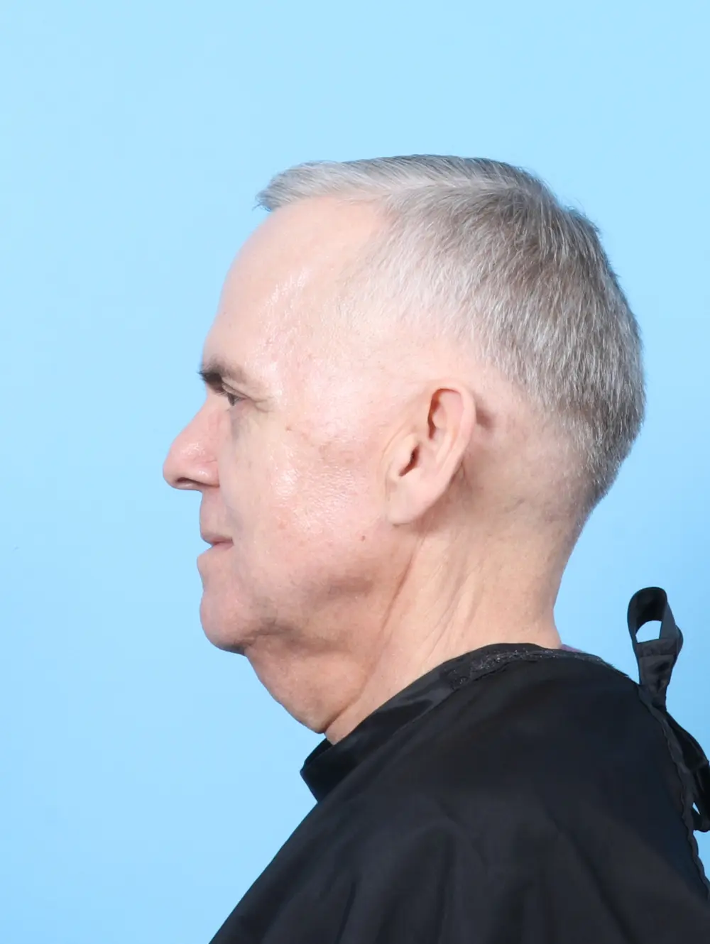 Eyelid Surgery Patient Photo - Case 57697 - after view-2