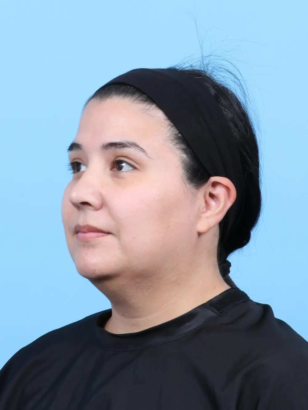 Liposuction Patient Photo - Case 57713 - before view-1
