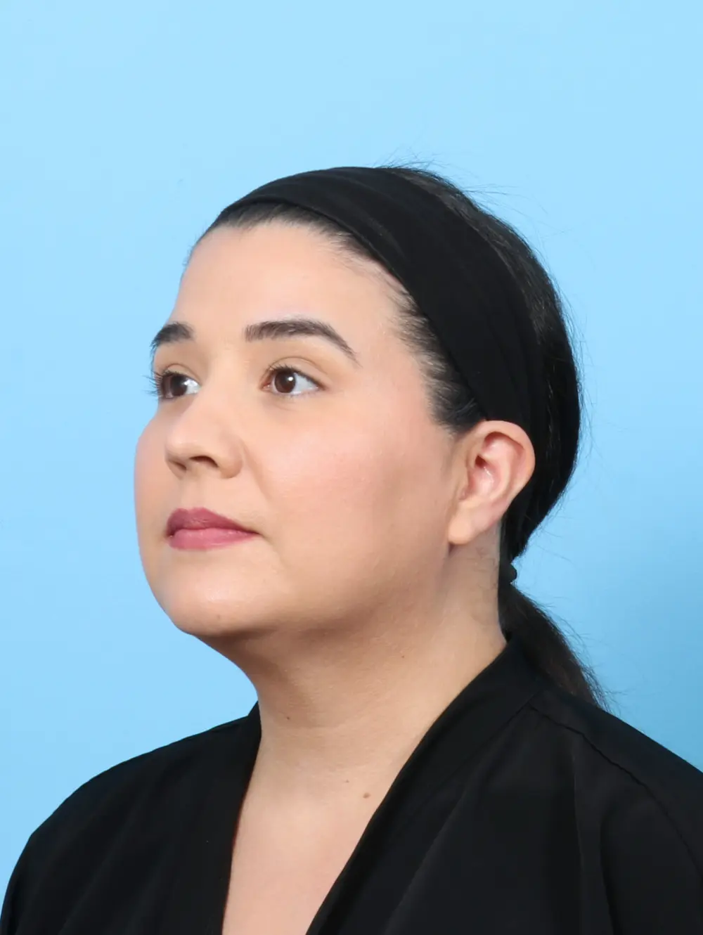 Liposuction Patient Photo - Case 57713 - after view-1