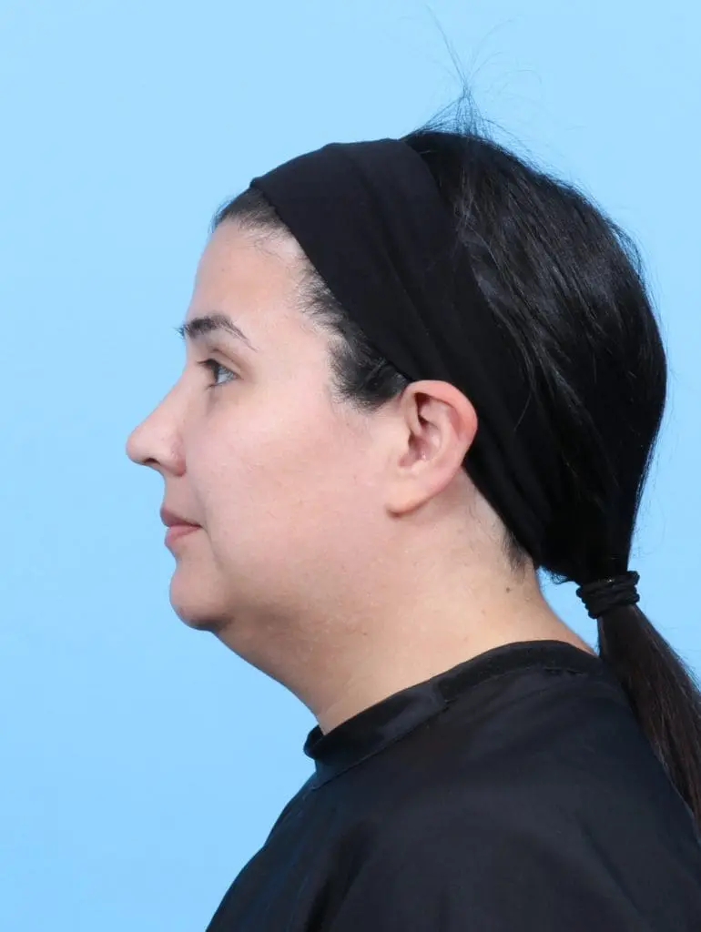 Liposuction - Case 57713 - Before