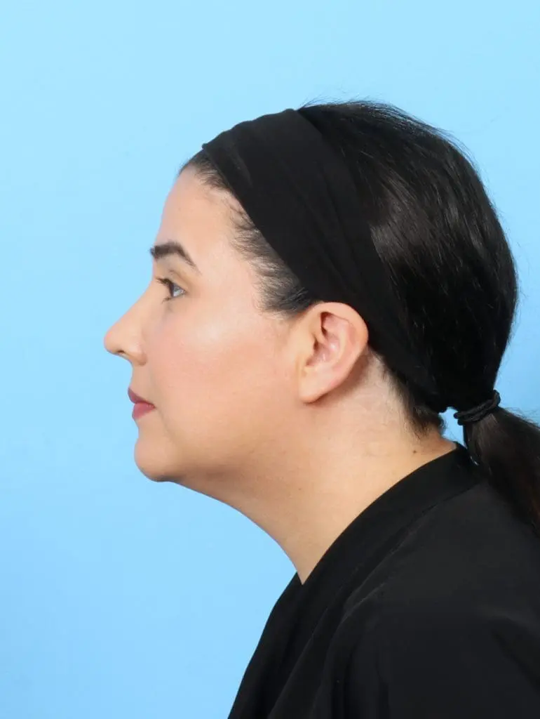 Liposuction - Case 57713 - After