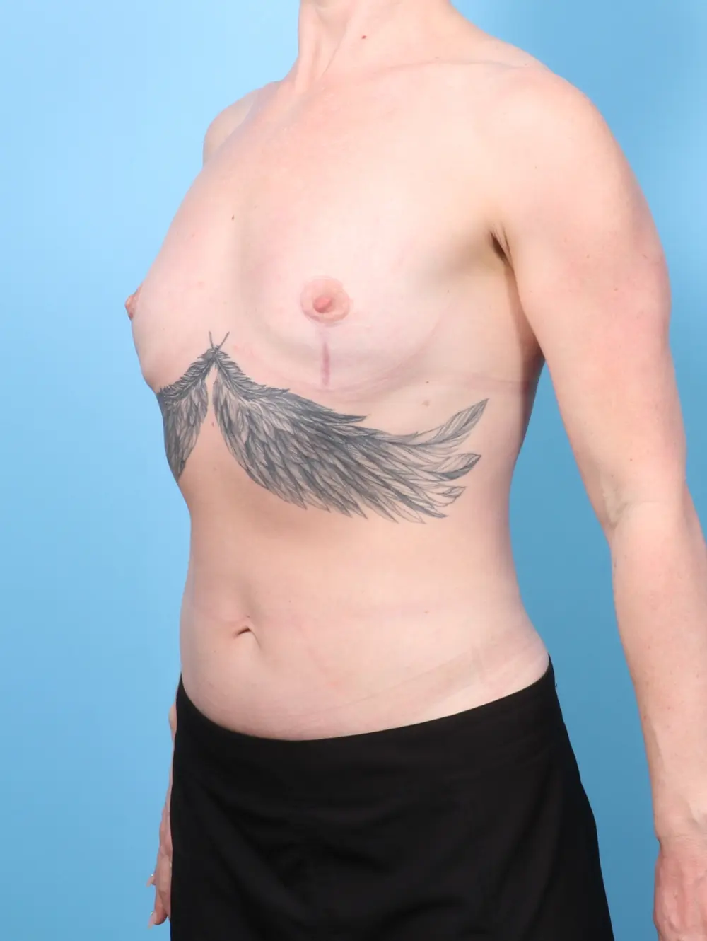 Breast Implant Removal Patient Photo - Case 57739 - after view-1