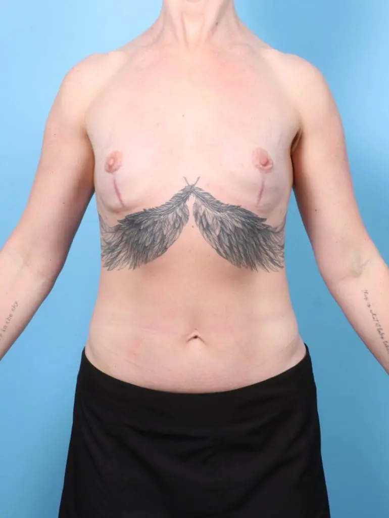 Breast Implant Removal - Case 57739 - After