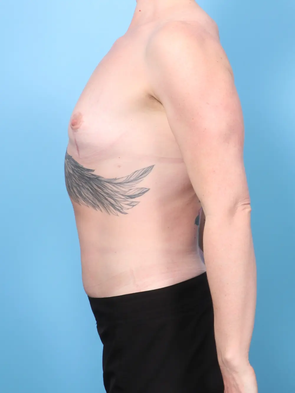 Breast Implant Removal Patient Photo - Case 57739 - after view-2