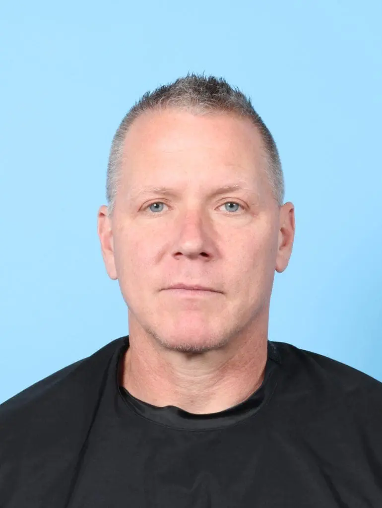 Eyelid Surgery - Case 57771 - After