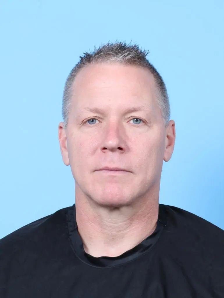 Eyelid Surgery - Case 57771 - Before