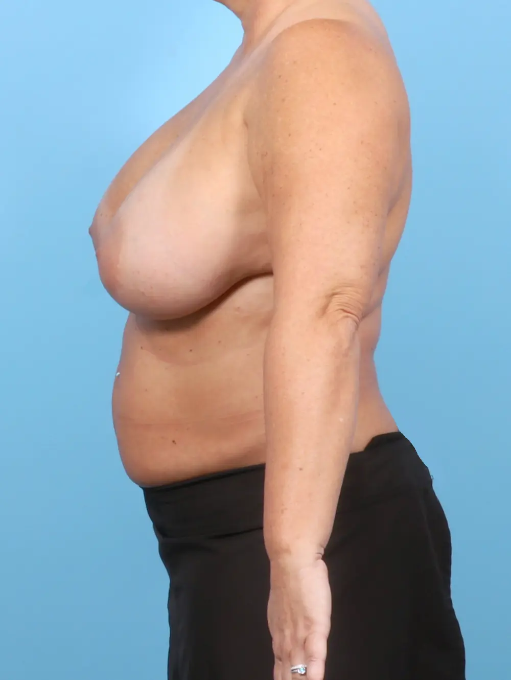 Breast Implant Removal Patient Photo - Case 57809 - before view-2