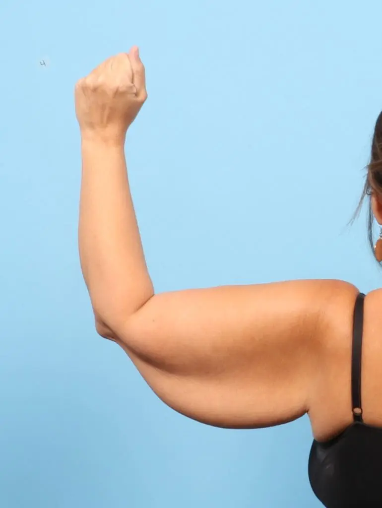 After Weight Loss - Case 57952 - Before