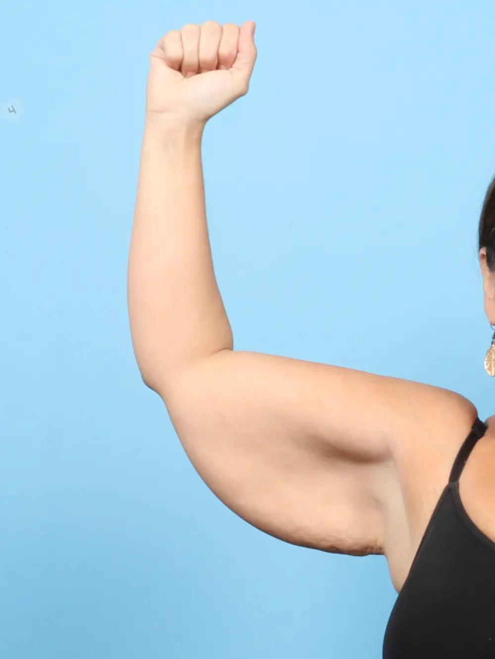 After Weight Loss Patient Photo - Case 57952 - before view-1