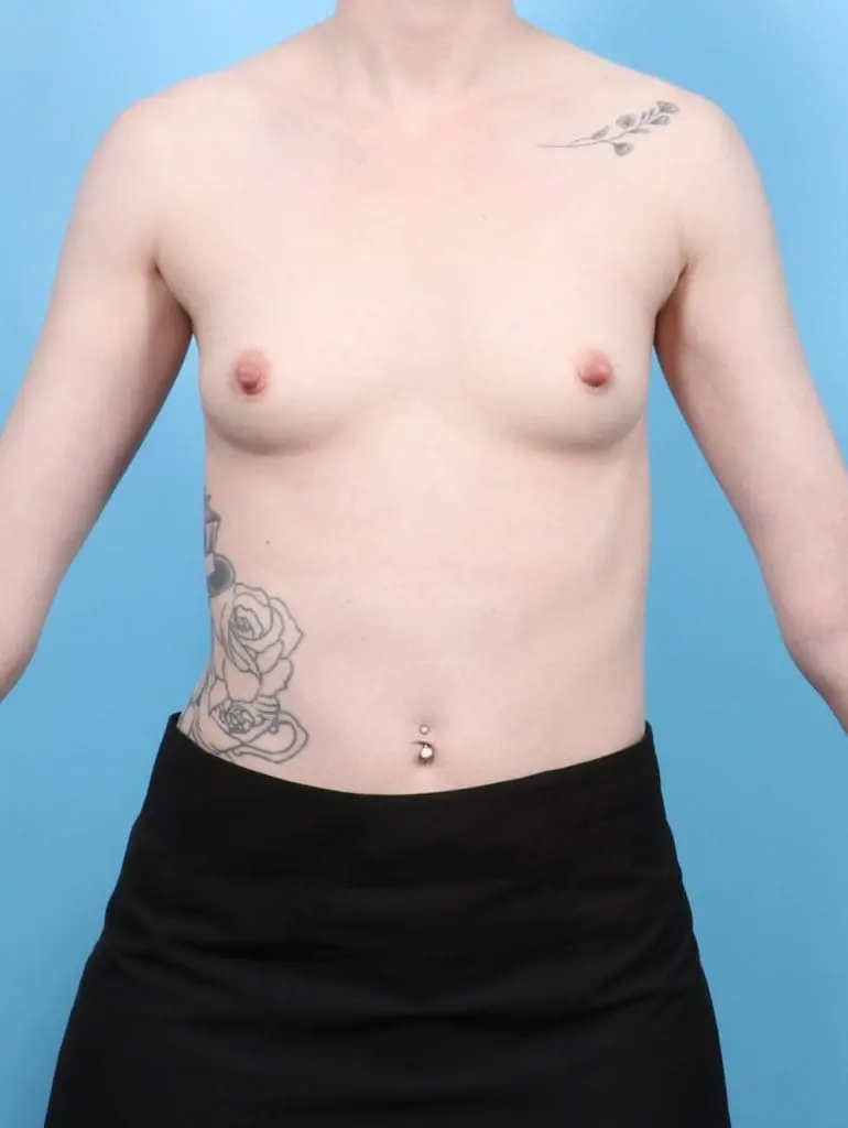 Breast Augmentation - Case 57958 - Before