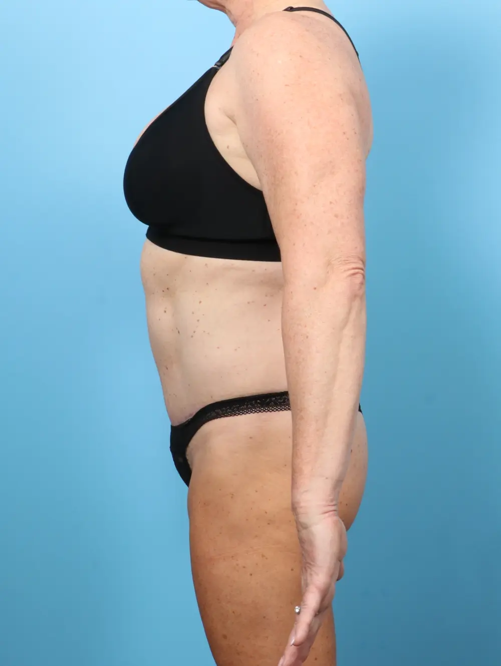 Tummy Tuck Patient Photo - Case 57966 - after view-2