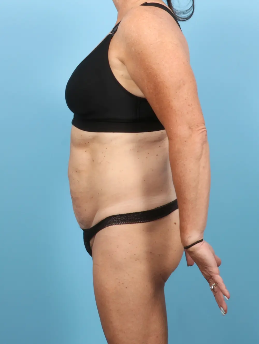 Tummy Tuck Patient Photo - Case 57966 - before view-2