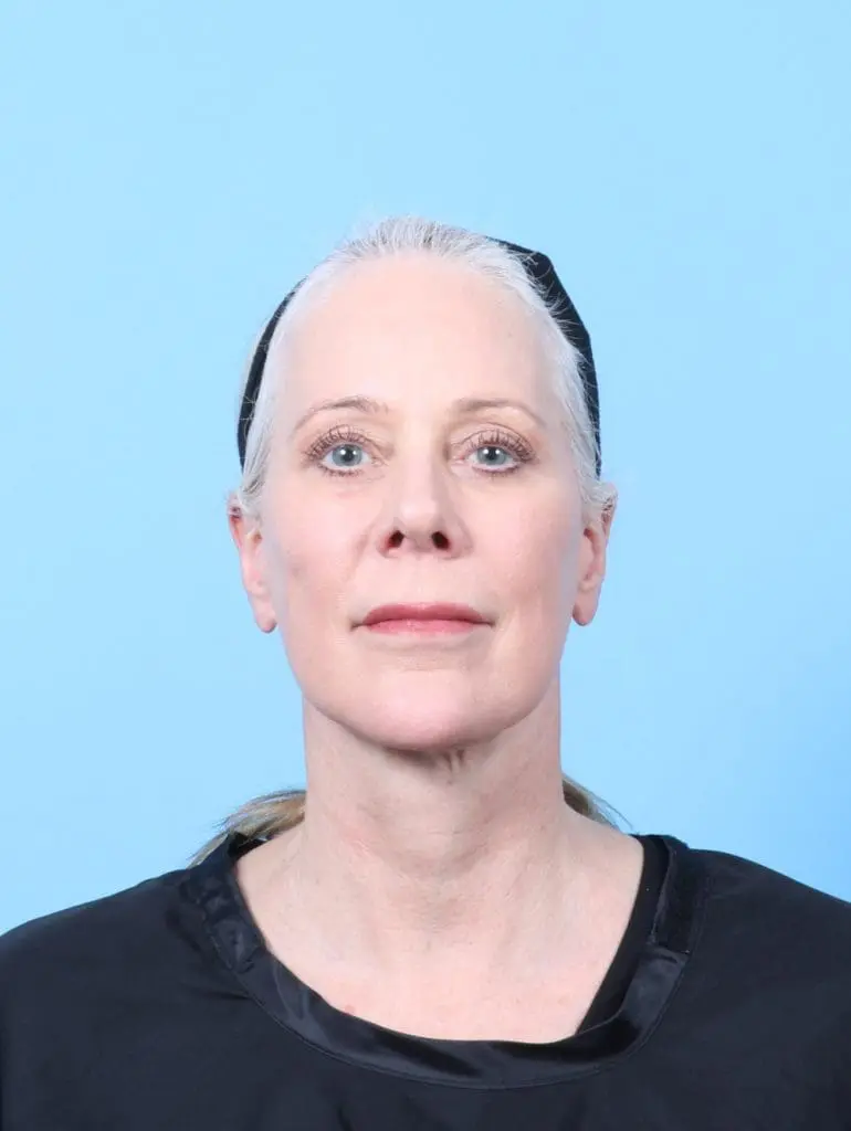 Facelift / Neck Lift - Case 57992 - After