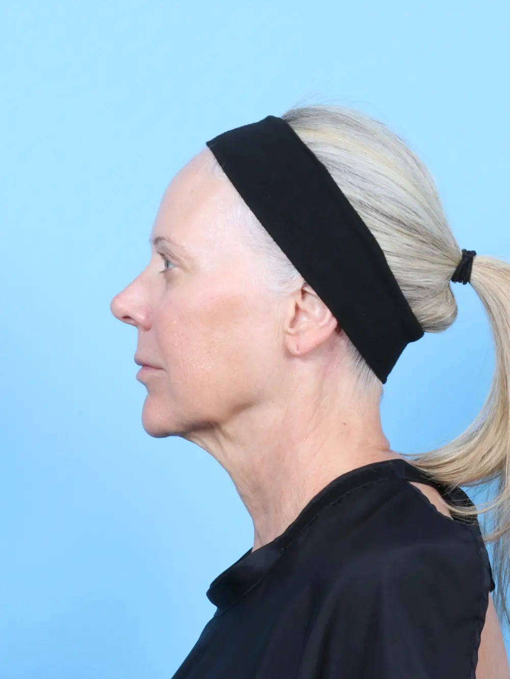 Facelift / Neck Lift Patient Photo - Case 57992 - before view-2