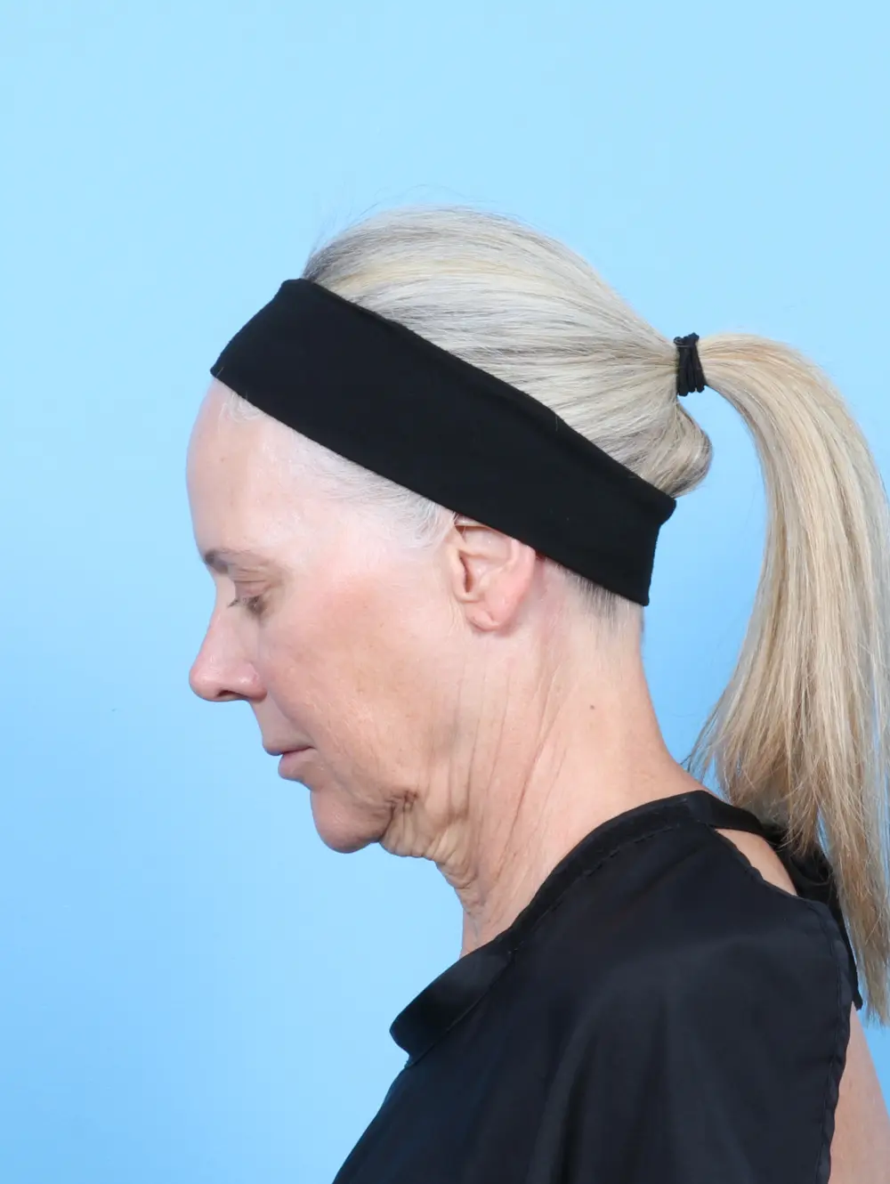 Facelift / Neck Lift Patient Photo - Case 57992 - before view-3