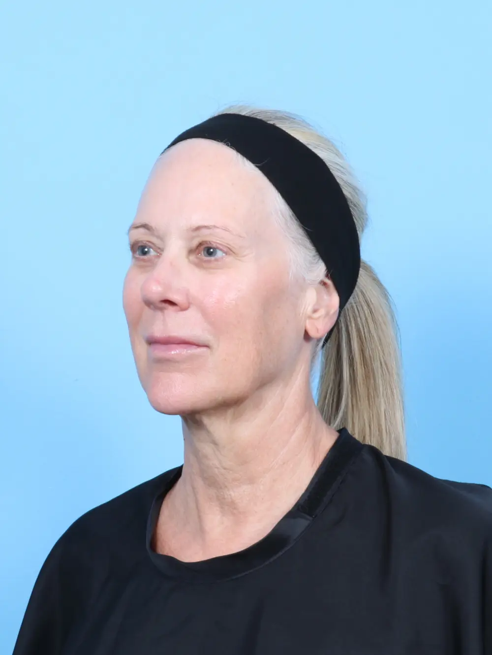 Facelift / Neck Lift Patient Photo - Case 57992 - before view-1