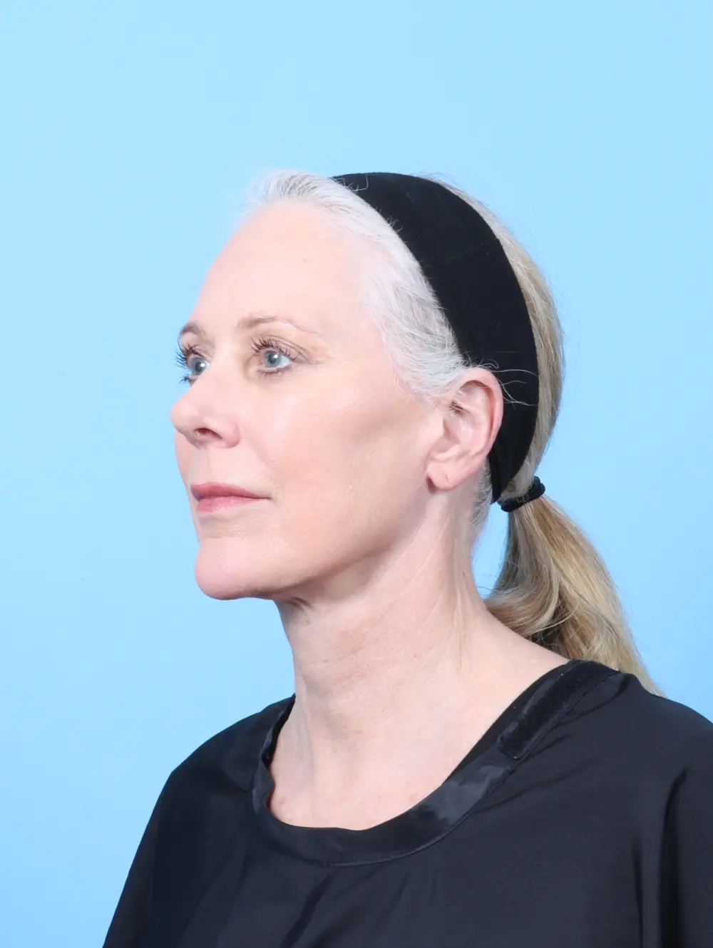 Facelift / Neck Lift Patient Photo - Case 57992 - after view-1
