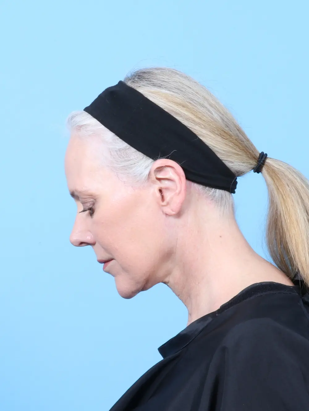 Facelift / Neck Lift Patient Photo - Case 57992 - after view-3