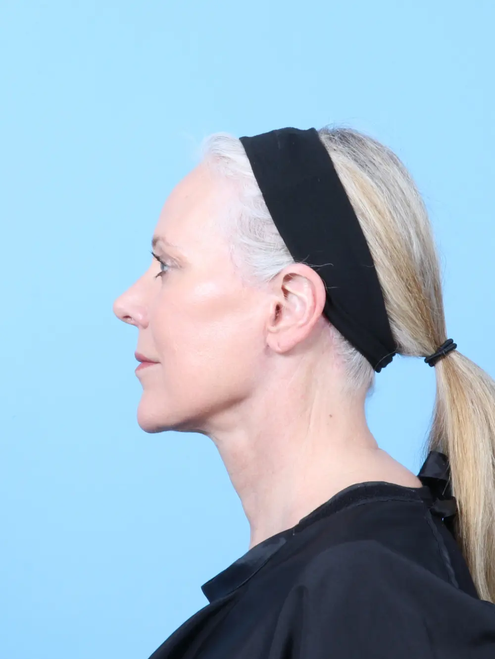 Facelift / Neck Lift Patient Photo - Case 57992 - after view-2