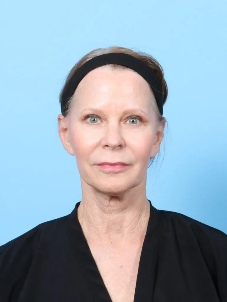 Eyelid Surgery - Case 58048 - After