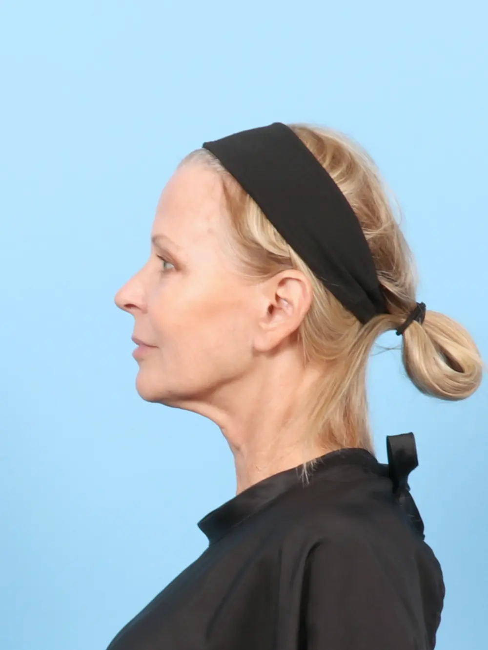 Eyelid Surgery Patient Photo - Case 58048 - before view-2