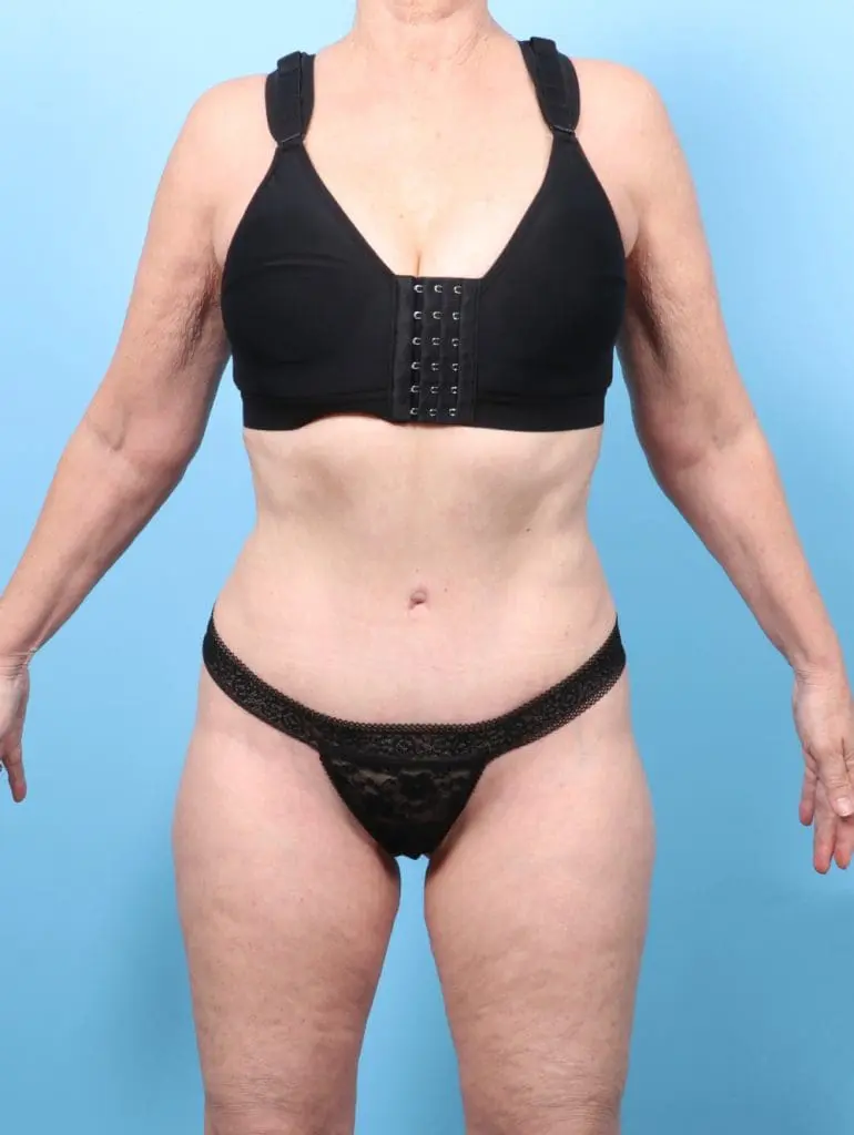 Tummy Tuck - Case 58034 - After