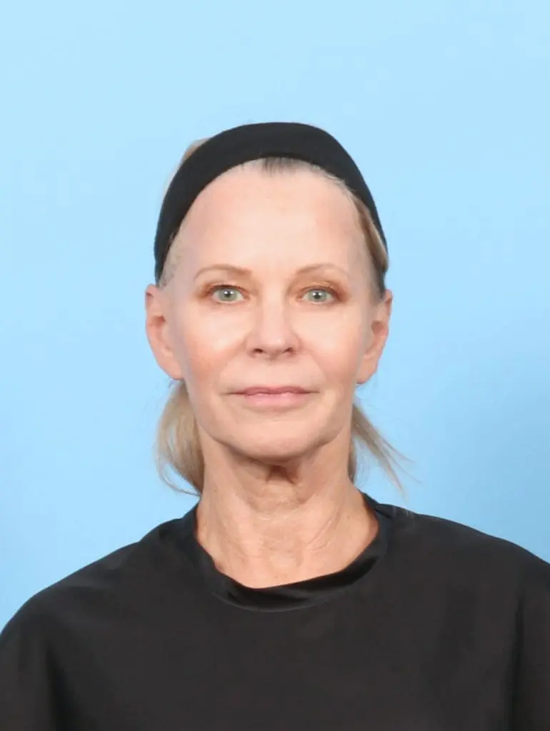 Eyelid Surgery - Case 58048 - Before