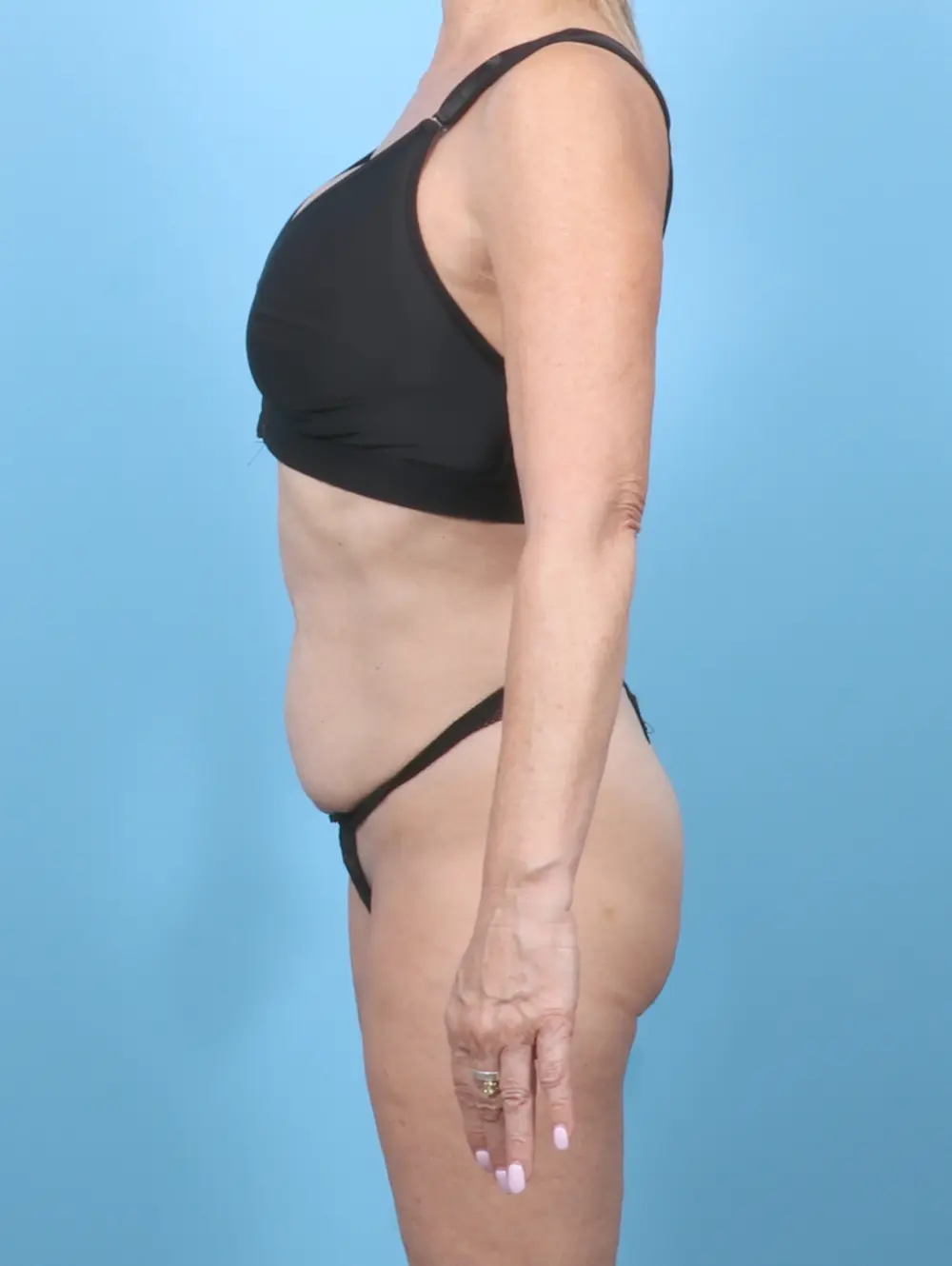 Tummy Tuck Patient Photo - Case 58034 - before view-2