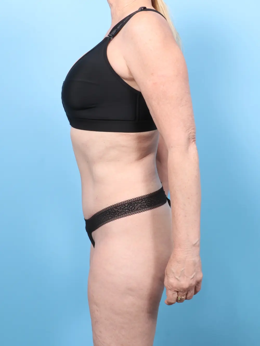 Tummy Tuck Patient Photo - Case 58034 - after view-2