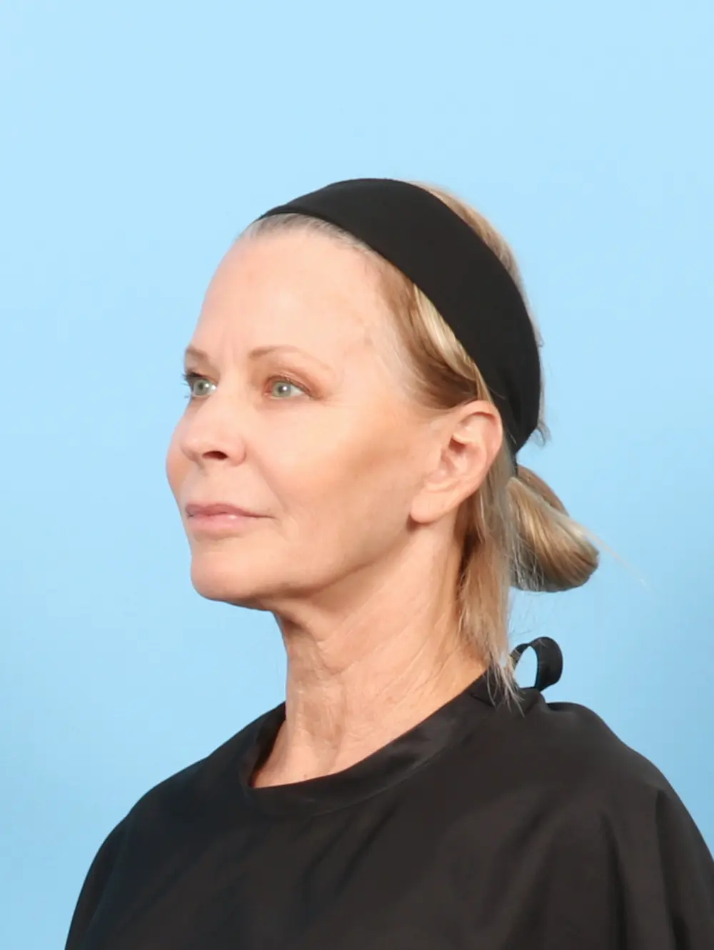 Eyelid Surgery Patient Photo - Case 58048 - before view-1