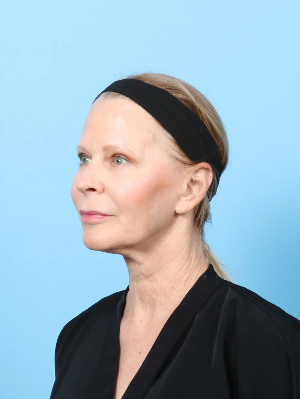 Eyelid Surgery Patient Photo - Case 58048 - after view-1