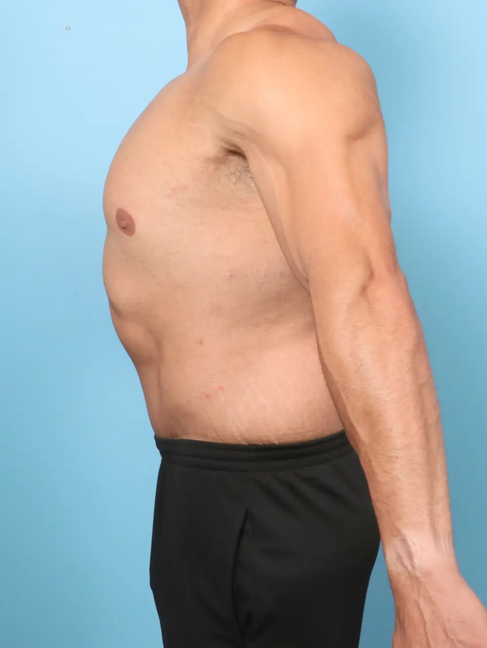 After Weight Loss Patient Photo - Case 58065 - after view-2